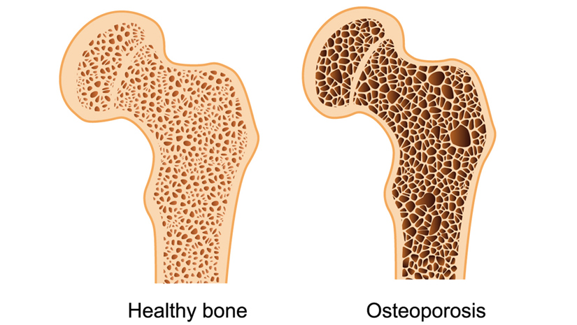 Osteoporosis-is-often.jpg