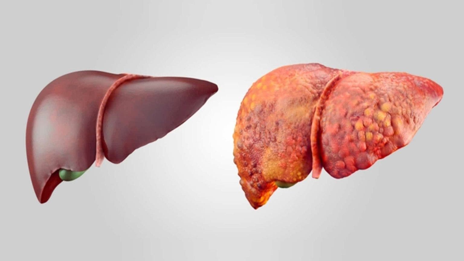 الفرق بين الكبد الطبيعي والكبد الدهني
