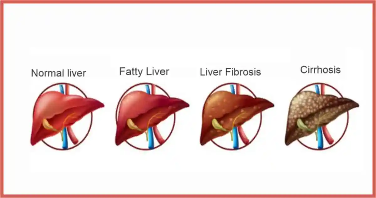 مراحل تلف الكبد 