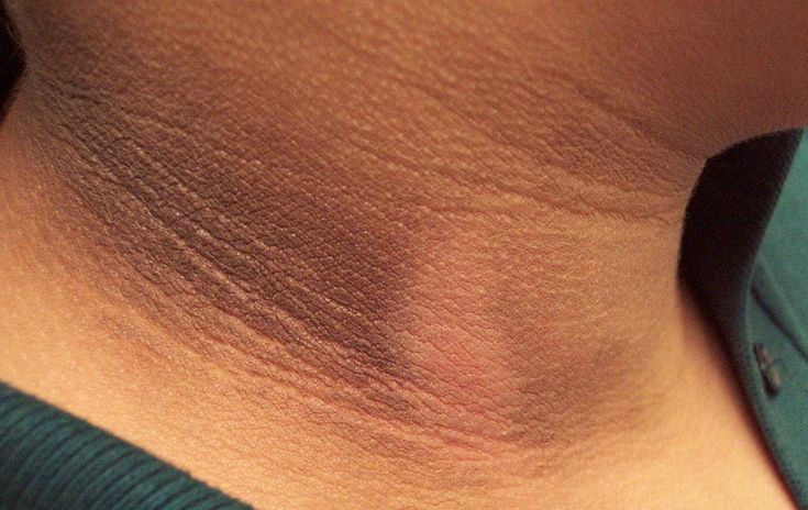 تحول لون الجلد نتيجة مقاومة الانسولين 