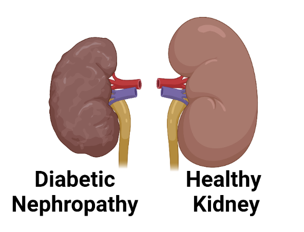 diabetes and kidney disease