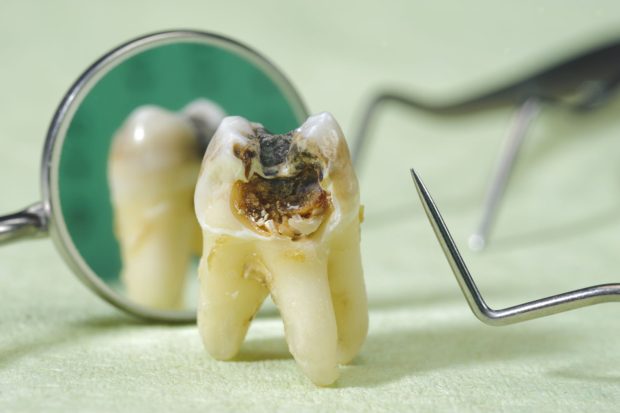 ظهور بقع أو حفر في الاسنان