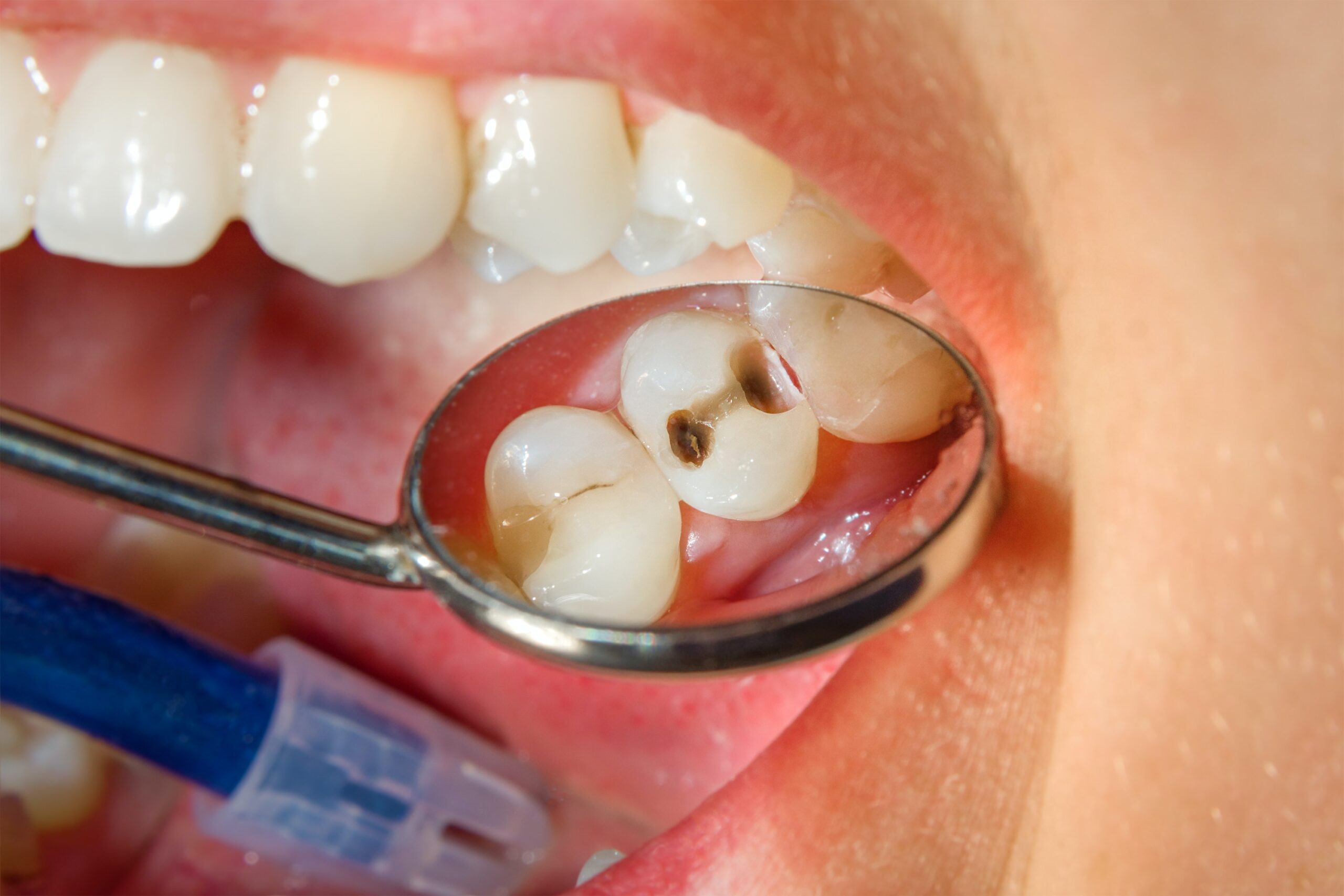 معالجة تسوس الاسنان
