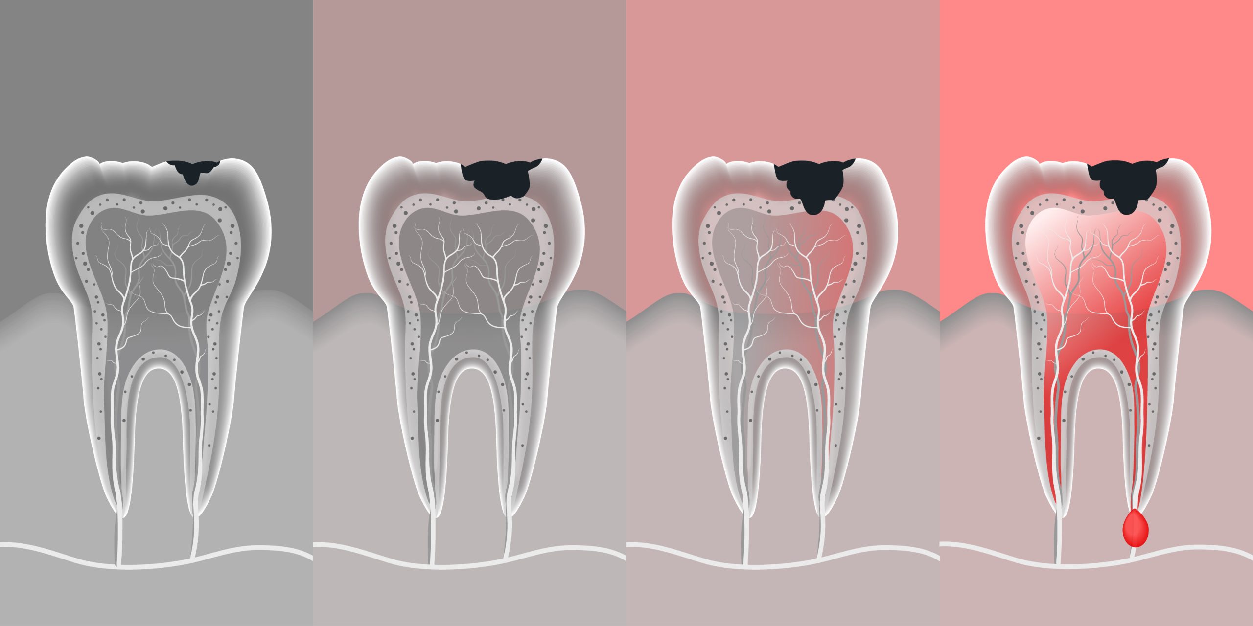 tooth-cavity-scaled.jpg
