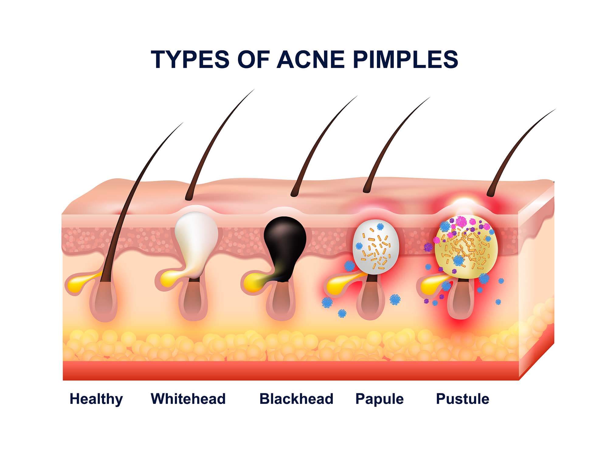 types-of-acne.jpg