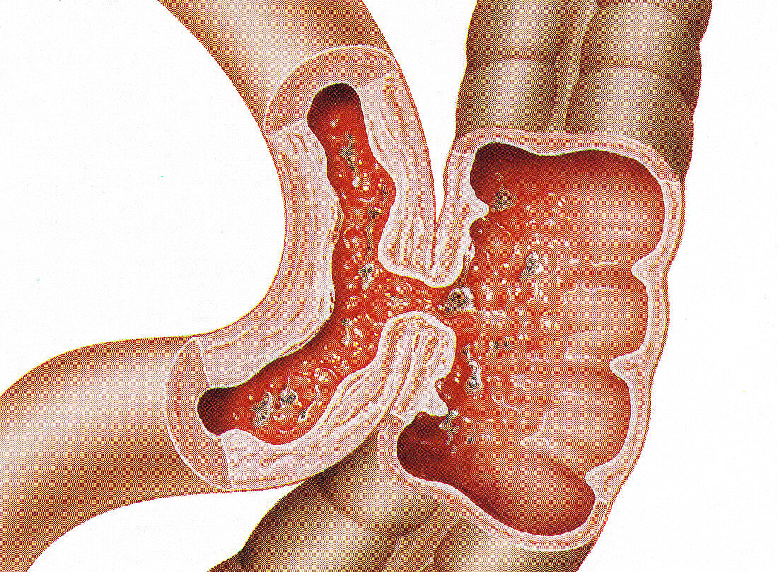 13376817-Intestinal-fistula-illustration.jpg