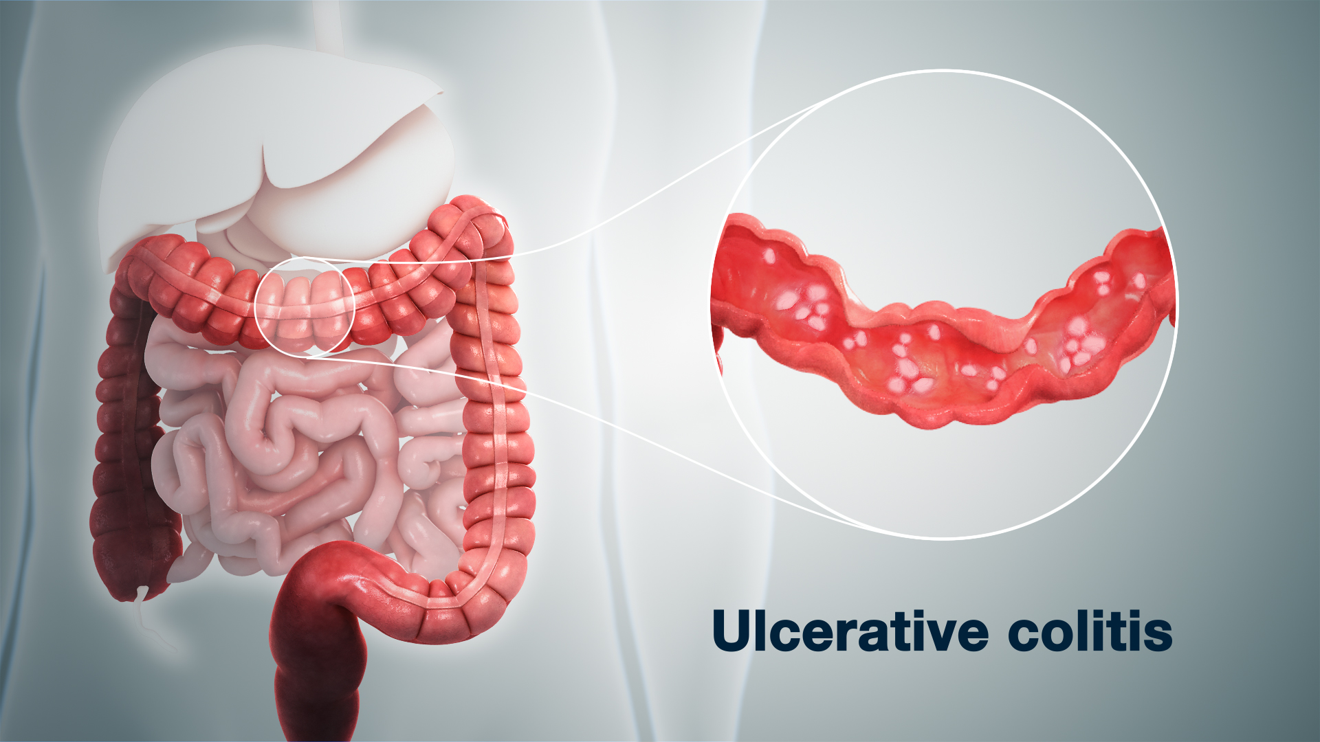 3D-medical-animation-of-Ulcerative-Colitis.jpg