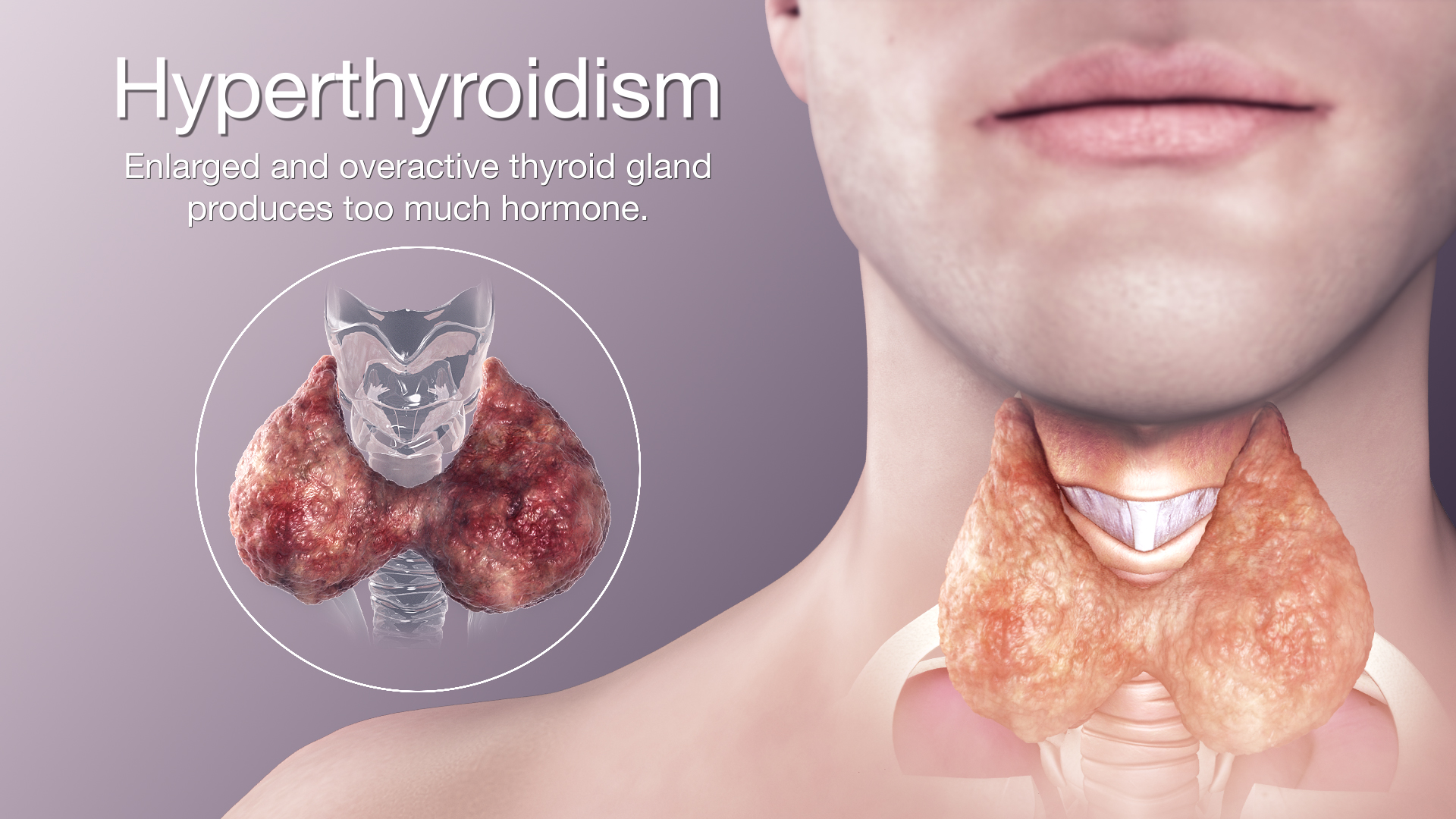 Hyperthyroidism.jpg