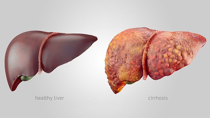 cirrhosis