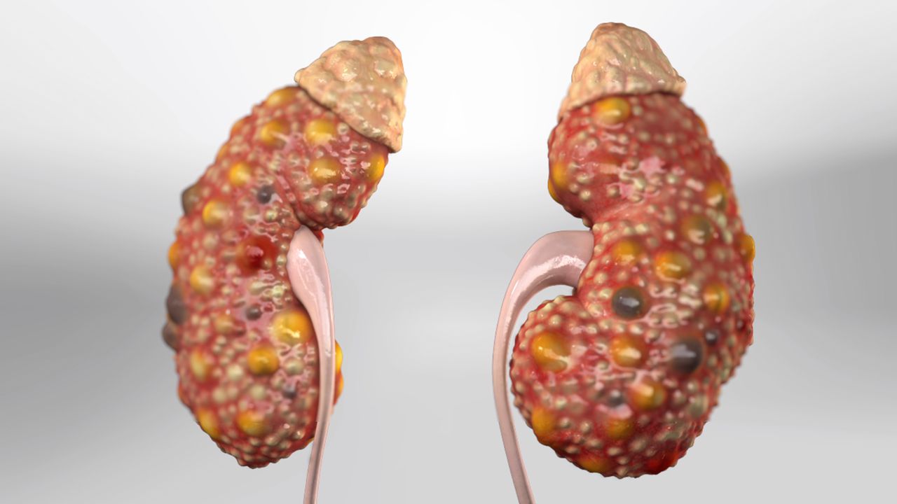 polycystickidneydisease_1280.jpg