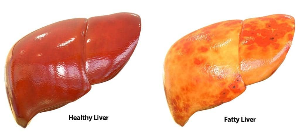 Healthy-versus-Fatty-Liver-1-1.jpeg