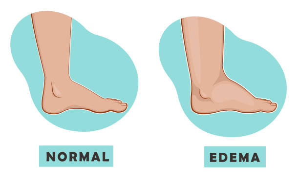 edema-diagram-612x612-1-1.jpeg