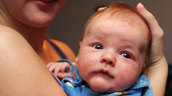 How-to-Recognize-and-Treat-Infant-Eczema-Atopic-Dermatitis-722x406-1.jpg