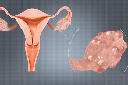 1200px-Polycystic_Ovaries.jpg