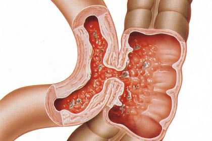 13376817-Intestinal-fistula-illustration.jpg