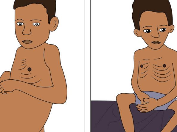 كواشيوركور و مارازمس: أمراض سوء التغذية