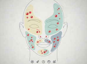 تحديد سبب حب الشباب من موقعه و طرق علاجه