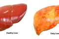 Healthy-versus-Fatty-Liver-1-1.jpeg