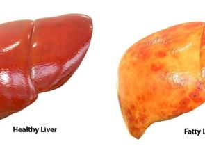 الكبد الدهني والسكري: ارتباط خفي بين المرضين