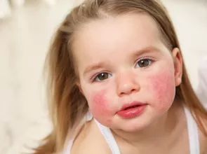 كيف تتعامل مع رد الفعل التحسسي (الحساسية) تجاه الطعام لدى طفلك؟