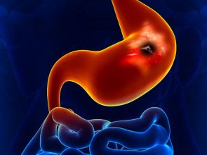 علاجات منزلية للتخلص من للقرحة