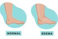 edema-diagram-612x612-1-1.jpeg