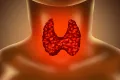 hypothyroidism.png.webp