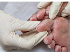 القدم السكري