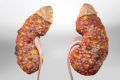 polycystickidneydisease_1280.jpg