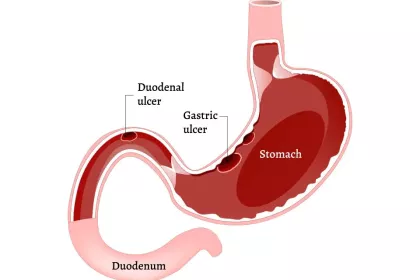 ulcer.webp